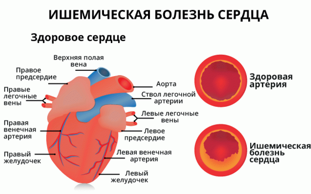 Ишемическая болезнь это заболевание. Ишемическая болезнь сердца (ИБС).